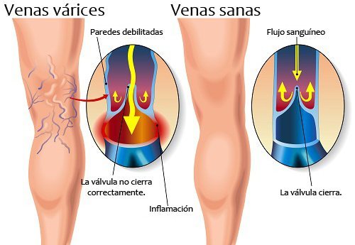 Conferencia Gratuita Sobre Circulación Y Varices